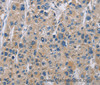 Immunohistochemistry of paraffin-embedded Human liver cancer tissue using NME5 Polyclonal Antibody at dilution 1:50