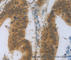 Immunohistochemistry of paraffin-embedded Human colon cancer using TNFRSF11B Polyclonal Antibody at dilution of 1:30