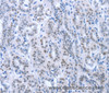 Immunohistochemistry of paraffin-embedded Human thyroid cancer using PAX8 Polyclonal Antibody at dilution of 1:35