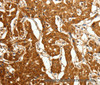 Immunohistochemistry of paraffin-embedded Human lung cancer using Otocadherin Polyclonal Antibody at dilution of 1:80