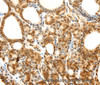 Immunohistochemistry of paraffin-embedded Human thyroid cancer using Otocadherin Polyclonal Antibody at dilution of 1:80