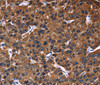 Immunohistochemistry of paraffin-embedded Human liver cancer using PHB Polyclonal Antibody at dilution of 1:30
