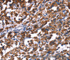 Immunohistochemistry of paraffin-embedded Human thyroid cancer using PHB Polyclonal Antibody at dilution of 1:30