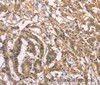 Immunohistochemistry of paraffin-embedded Human colon cancer using PEBP1 Polyclonal Antibody at dilution of 1:40