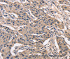 Immunohistochemistry of paraffin-embedded Human lung cancer using PEBP1 Polyclonal Antibody at dilution of 1:40