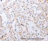 Immunohistochemistry of paraffin-embedded Human lung cancer tissue using SERP1 Polyclonal Antibody at dilution 1:30