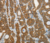 Immunohistochemistry of paraffin-embedded Human thyroid cancer tissue using PRDX5 Polyclonal Antibody at dilution 1:40