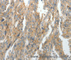 Immunohistochemistry of paraffin-embedded Human ovarian cancer tissue using PRDX5 Polyclonal Antibody at dilution 1:40