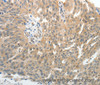 Immunohistochemistry of paraffin-embedded Human ovarian cancer tissue using E-Selectin Polyclonal Antibody at dilution of 1:40