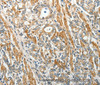 Immunohistochemistry of paraffin-embedded Human gastric cancer using E-Selectin Polyclonal Antibody at dilution of 1:40