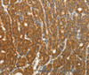 Immunohistochemistry of paraffin-embedded Human thyroid cancer using PTCH1 Polyclonal Antibody at dilution of 1:50