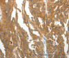 Immunohistochemistry of paraffin-embedded Human ovarian cancer tissue using RGS2 Polyclonal Antibody at dilution 1:40
