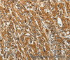 Immunohistochemistry of paraffin-embedded Human gastic cancer using RPLP0 Polyclonal Antibody at dilution of 1:40