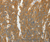 Immunohistochemistry of paraffin-embedded Human ovarian cancer using RPLP0 Polyclonal Antibody at dilution of 1:40