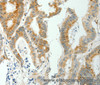 Immunohistochemistry of paraffin-embedded Human colon cancer tissue using SELENOM Polyclonal Antibody at dilution 1:50