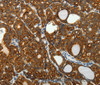 Immunohistochemistry of paraffin-embedded Human thyroid cancer tissue using SELENOM Polyclonal Antibody at dilution 1:50