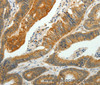Immunohistochemistry of paraffin-embedded Human colon cancer using SH-PTP1 Polyclonal Antibody at dilution of 1:35