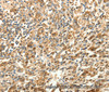 Immunohistochemistry of paraffin-embedded Human gastric cancer using SLC25A11 Polyclonal Antibody at dilution of 1:30