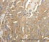 Immunohistochemistry of paraffin-embedded Human ovarian cancer tissue using SFTPD Polyclonal Antibody at dilution 1:30