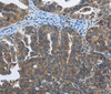 Immunohistochemistry of paraffin-embedded Human ovarian cancer tissue using SYT3 Polyclonal Antibody at dilution 1:40