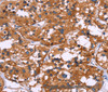 Immunohistochemistry of paraffin-embedded Human thyroid cancer tissue using SYT4 Polyclonal Antibody at dilution 1:60