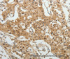 Immunohistochemistry of paraffin-embedded Human lung cancer tissue using SYT6 Polyclonal Antibody at dilution 1:40