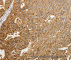 Immunohistochemistry of paraffin-embedded Human ovarian cancer tissue using TFF2 Polyclonal Antibody at dilution 1:40