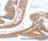 Immunohistochemistry of paraffin-embedded Human colon cancer tissue using TGFA Polyclonal Antibody at dilution 1:60