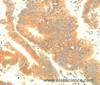 Immunohistochemistry of paraffin-embedded Human colon cancer using TRAF3IP2 Polyclonal Antibody at dilution of 1:30