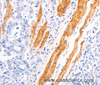 Immunohistochemistry of paraffin-embedded Human gastric cancer using TPM1 Polyclonal Antibody at dilution of 1:40