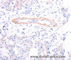 Immunohistochemistry of paraffin-embedded Human breast cancer using TPM1 Polyclonal Antibody at dilution of 1:40