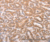 Immunohistochemistry of paraffin-embedded Human thyroid cancer tissue using TRPV4 Polyclonal Antibody at dilution 1:40