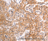 Immunohistochemistry of paraffin-embedded Human liver cancer tissue using TRPV4 Polyclonal Antibody at dilution 1:40