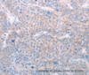 Immunohistochemistry of paraffin-embedded Human liver cancer tissue using SPATA6 Polyclonal Antibody at dilution 1:50