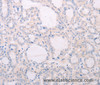 Immunohistochemistry of paraffin-embedded Human thyroid cancer tissue using TSHR Polyclonal Antibody at dilution 1:50