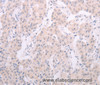 Immunohistochemistry of paraffin-embedded Human lung cancer tissue using TSHR Polyclonal Antibody at dilution 1:50