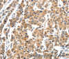 Immunohistochemistry of paraffin-embedded Human breast cancer tissue using XBP1 Polyclonal Antibody at dilution 1:60