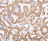 Immunohistochemistry of paraffin-embedded Human thyroid cancer using ATPIF1 Polyclonal Antibody at dilution of 1:50