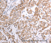 Immunohistochemistry of paraffin-embedded Human breast cancer using ATPIF1 Polyclonal Antibody at dilution of 1:50