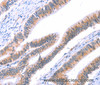 Immunohistochemistry of paraffin-embedded Human colon cancer tissue using VWF Polyclonal Antibody at dilution 1:50