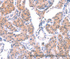 Immunohistochemistry of paraffin-embedded Human lung cancer tissue using VWF Polyclonal Antibody at dilution 1:50