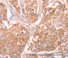 Immunohistochemistry of paraffin-embedded Human breast cancer using GC Polyclonal Antibody at dilution of 1:40