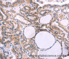 Immunohistochemistry of paraffin-embedded Human thyroid cancer using ST2 Polyclonal Antibody at dilution of 1:40