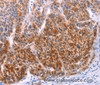 Immunohistochemistry of paraffin-embedded Human liver cancer using AADAC Polyclonal Antibody at dilution of 1:30