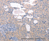 Immunohistochemistry of paraffin-embedded Human cervical cancer tissue using ABCF1 Polyclonal Antibody at dilution 1:40