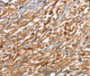 Immunohistochemistry of paraffin-embedded Human esophagus cancer using CAPG Polyclonal Antibody at dilution of 1:40