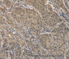 Immunohistochemistry of paraffin-embedded Human gastric cancer tissue using AGTRAP Polyclonal Antibody at dilution 1:40