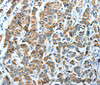 Immunohistochemistry of paraffin-embedded Human breast cancer using ALDH4A1 Polyclonal Antibody at dilution of 1:45