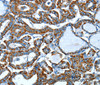 Immunohistochemistry of paraffin-embedded Human thyroid cancer using ALDH6A1 Polyclonal Antibody at dilution of 1:45