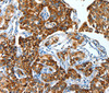 Immunohistochemistry of paraffin-embedded Human lung cancer using ALDH6A1 Polyclonal Antibody at dilution of 1:45